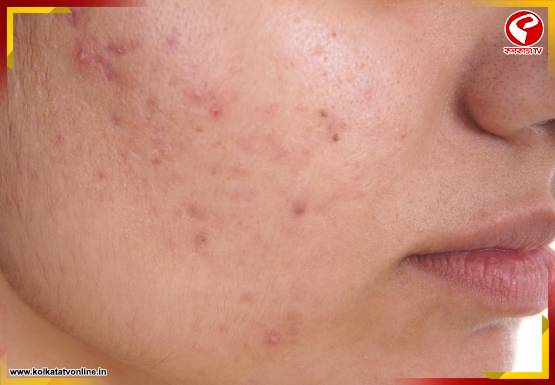 দ্রুত ভ্যানিস হবে ব্রণ, পুজোয় এই দুই উপাদানেই মিলবে নিখুঁত ত্বক